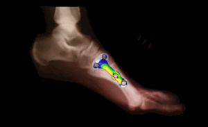 bone plate loading stresses on midfoot