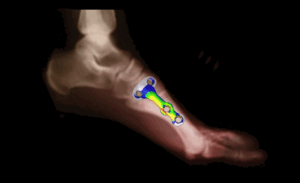 Knochenplatte mit Darstellung der Simulationsergebnisseam Mittelfußknochen
