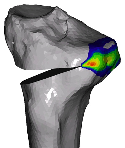 Plastic strains on a tibial head after knee osteotomy 