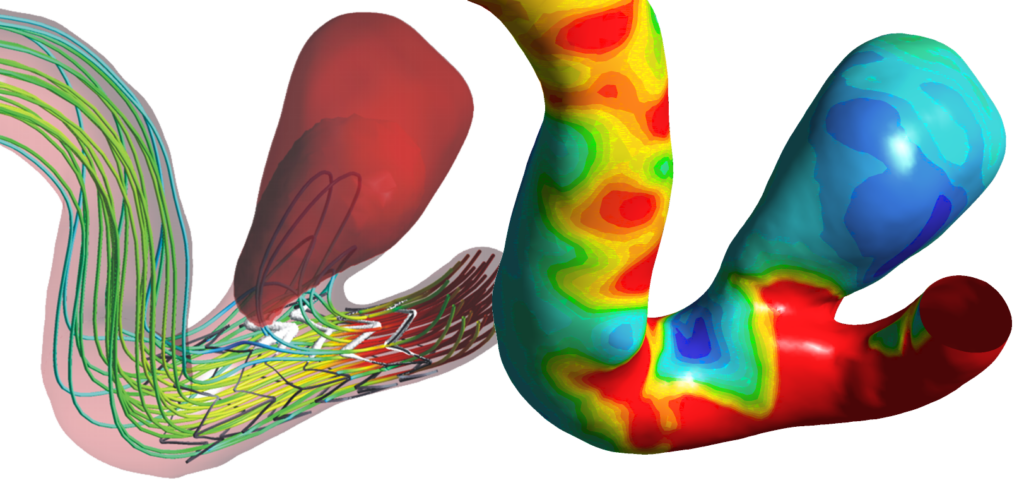 Beginnender Thrombus an einem Stent Stromlinien und Scherspannungen an einem Blutgefäß mit Aneurysma nach Stentimplantation