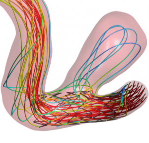 Stromlinien in einem Blutgefäß mit Aneurysma und Stent